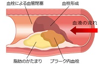 ストレスとコレステロール